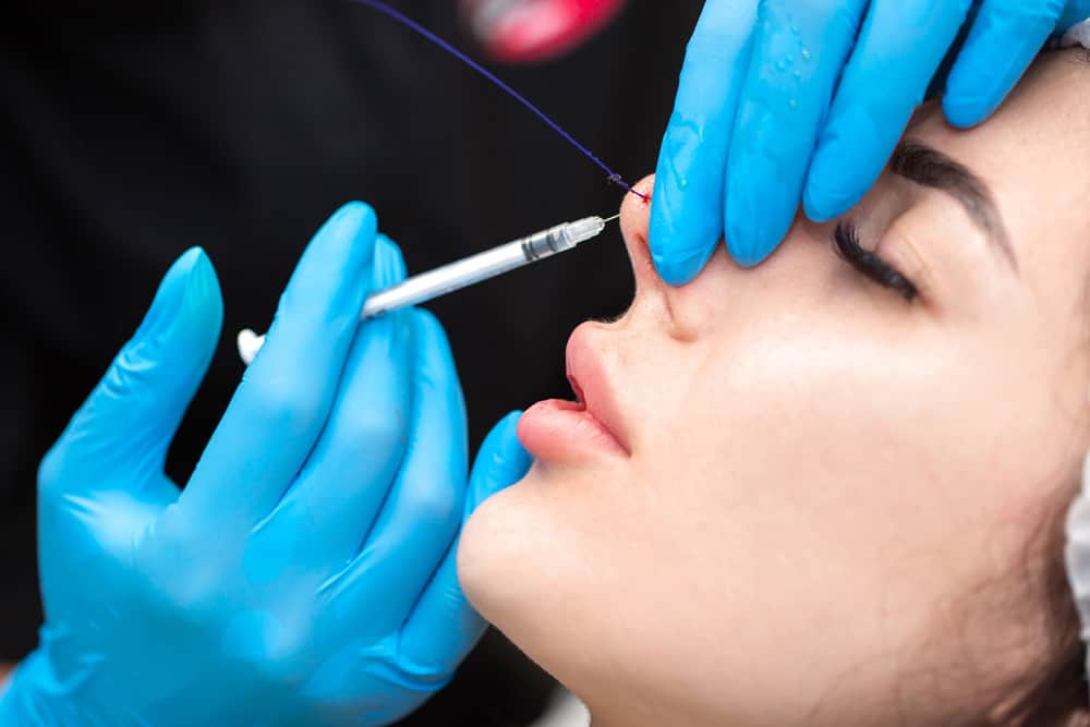 Nose Thread Lift